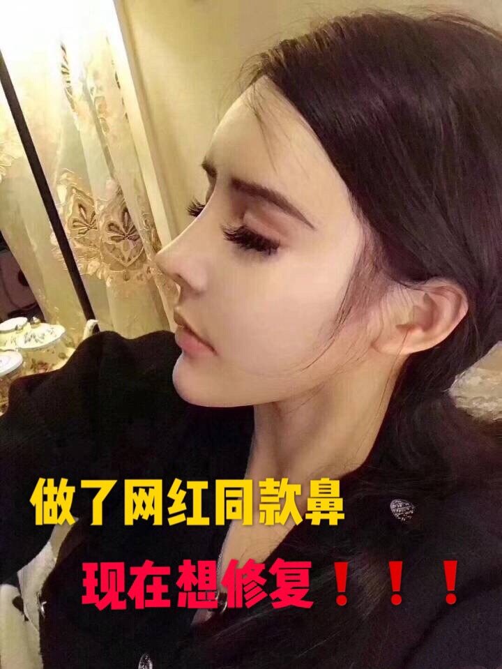 做了网红同款鼻,鼻梁现在挺高挺翘的,但是这鼻子在我脸上就是不好看