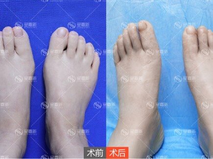 脚宽能缩窄 怎么做到的 脚宽 医学术语叫 前足 圈子 新氧美容整形