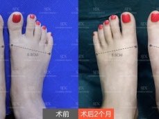 首页 此页面仅支持预览 Avatar 马桂文 1篇日记 脚宽能缩窄 怎么做到的 脚宽 医学术语叫 前足过宽 在医学美足领域 对于脚宽有严格测量标准 男性足宽平均为9 11 女性足宽平均为6 8厘米 超过了平均值 都称脚宽 脚宽带来的危害难以想象