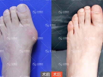 脚宽能缩窄 怎么做到的 脚宽 医学术语叫 前足 圈子 新氧美容整形