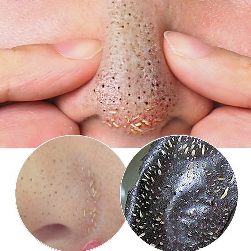 胶原纤维和弹力纤维重新排列,并恢复弹性,因此激光去黑头效果非常理想