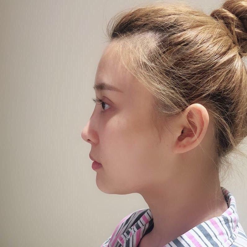 鼻基底凹陷单纯隆鼻有用吗?