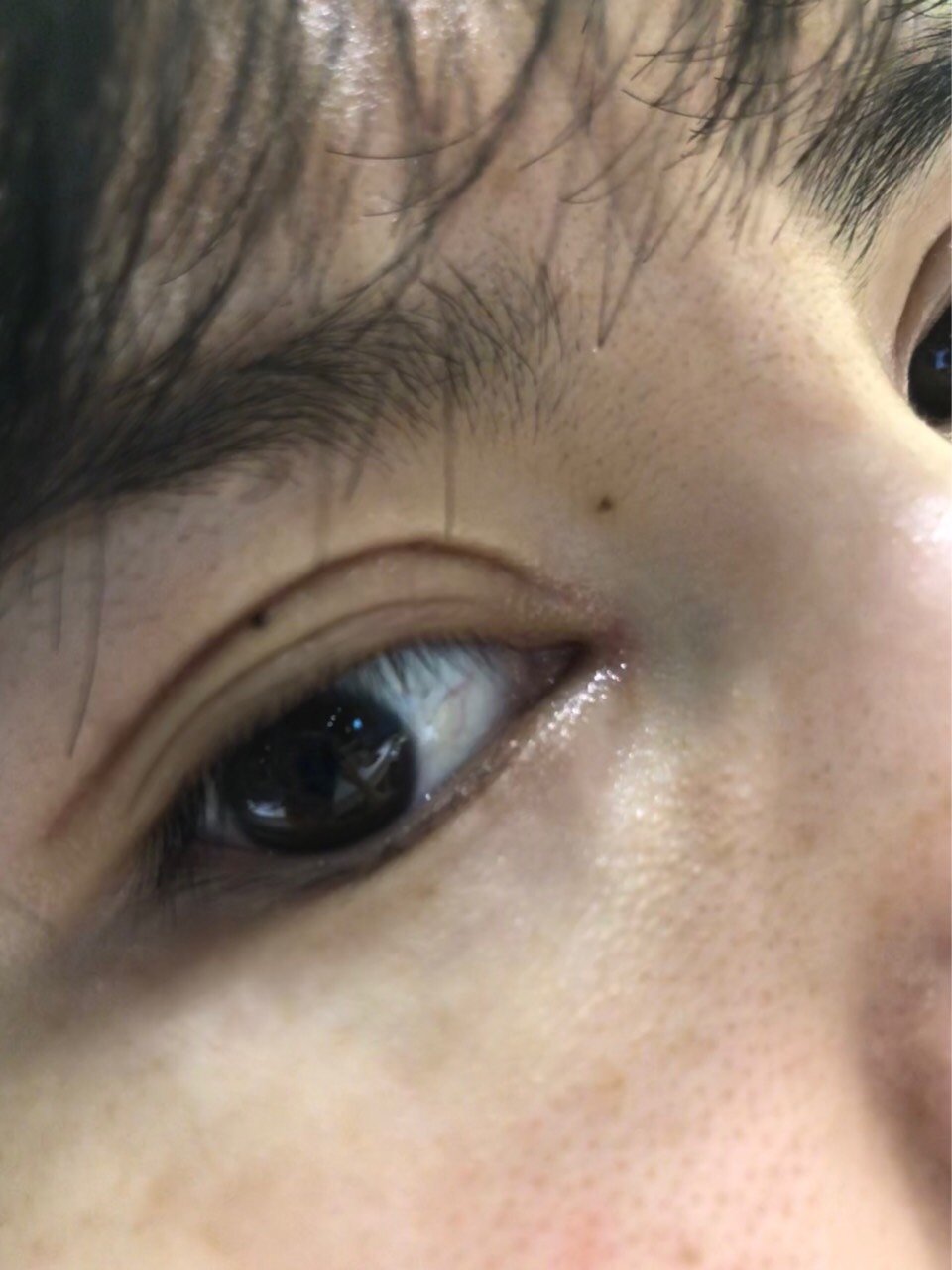 内双割了双眼皮后一个半月变三眼皮了,每天看着都很烦_圈子-新氧美容