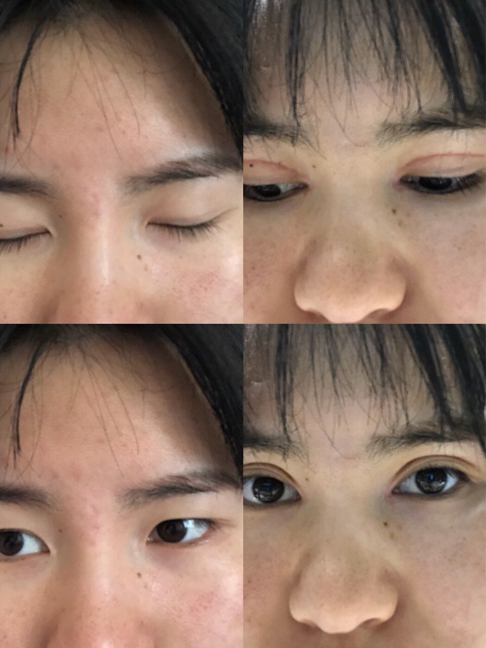 内双割了双眼皮后一个半月变三眼皮了,每天看着都很烦_圈子-新氧美容