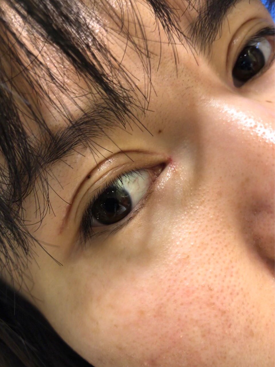 内双割了双眼皮后一个半月变三眼皮了,每天看着都很烦_圈子-新氧美容