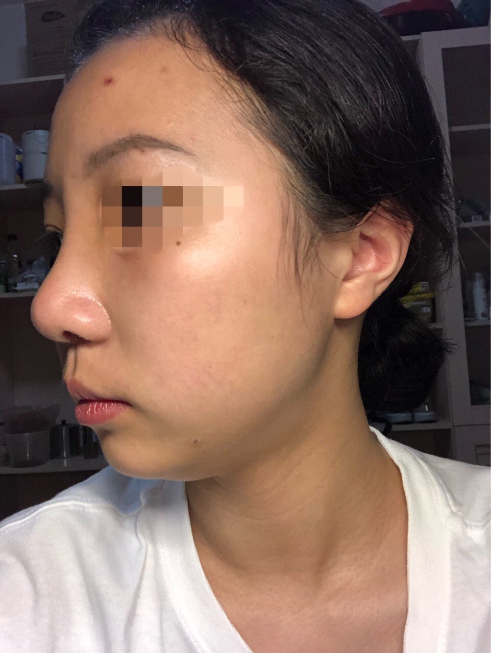 鼻部多项17天了,做了鼻头缩小但鼻头还是很圆钝,我这_圈子-新氧美容