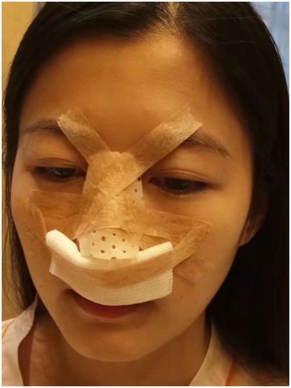 隆鼻手术的切口在哪开在哪里不易留疤很多求美