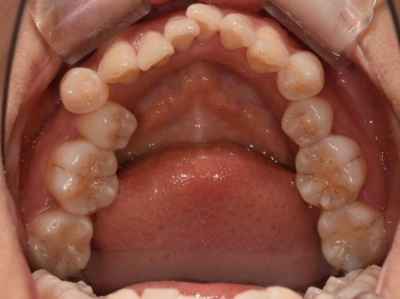 9797牙齿一直比较拥挤08,下前牙被智齿挤歪了,上面门_圈子-新氧