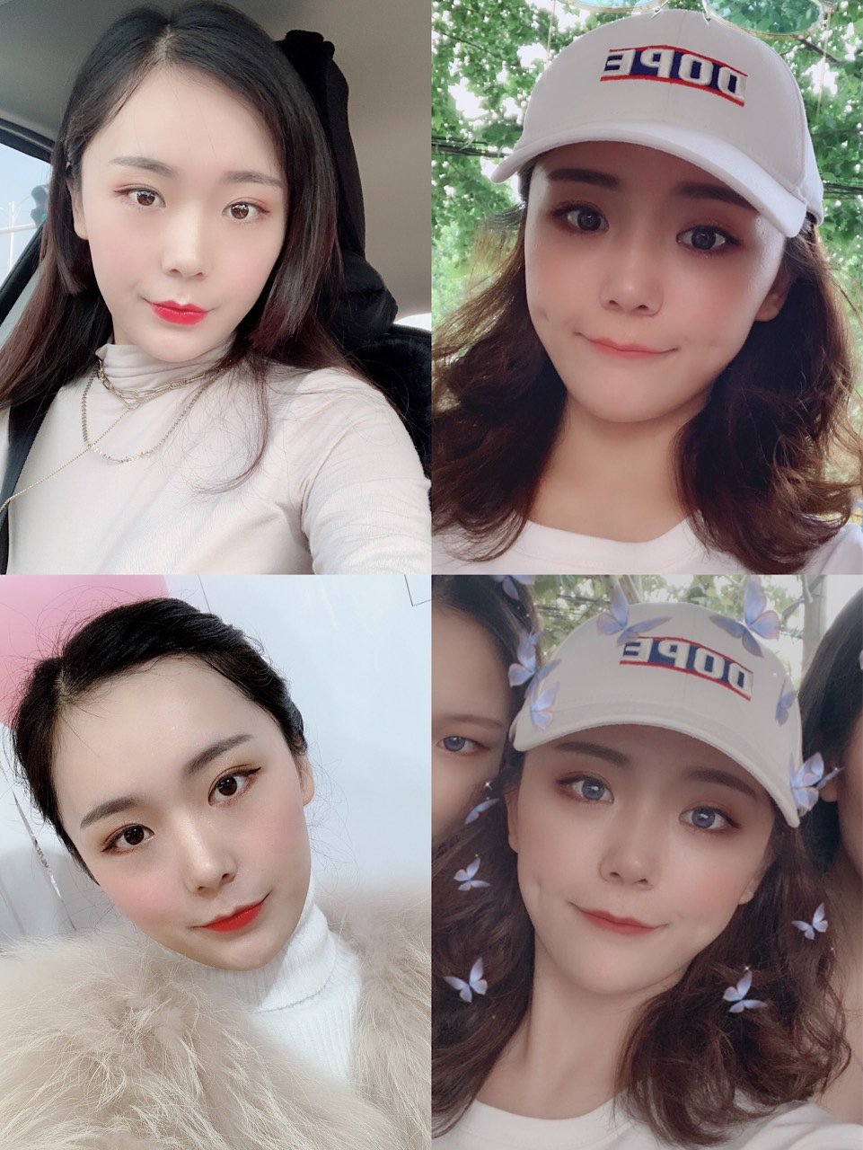 酒窝对比,做完酒窝显得更可爱些,没有酒窝就显得比较_圈子-新氧美容