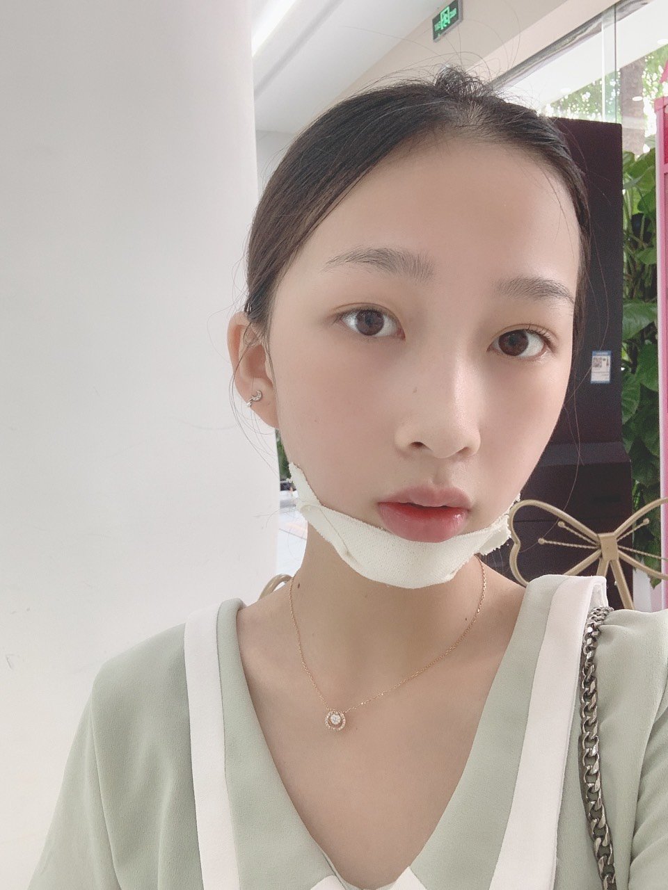 记录每一天的变化🥳手术:假体下巴原因:天生下巴后缩_圈子-新氧美容