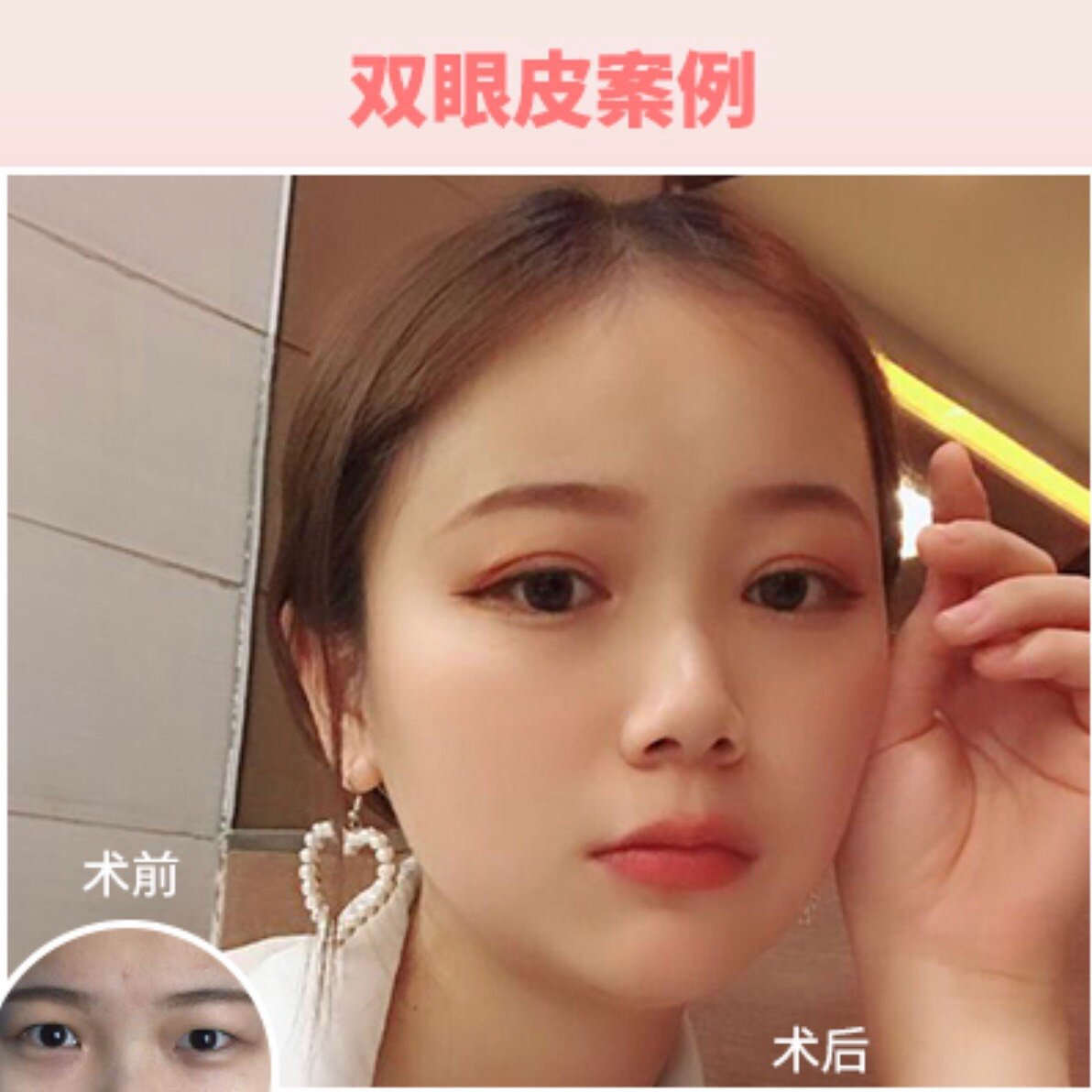 99697115虽然数不清的单眼皮女孩通过双眼皮手术重获新_圈子