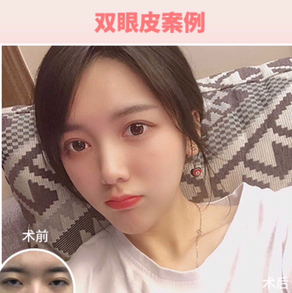 99697115虽然数不清的单眼皮女孩通过双眼皮手术重获新_圈子