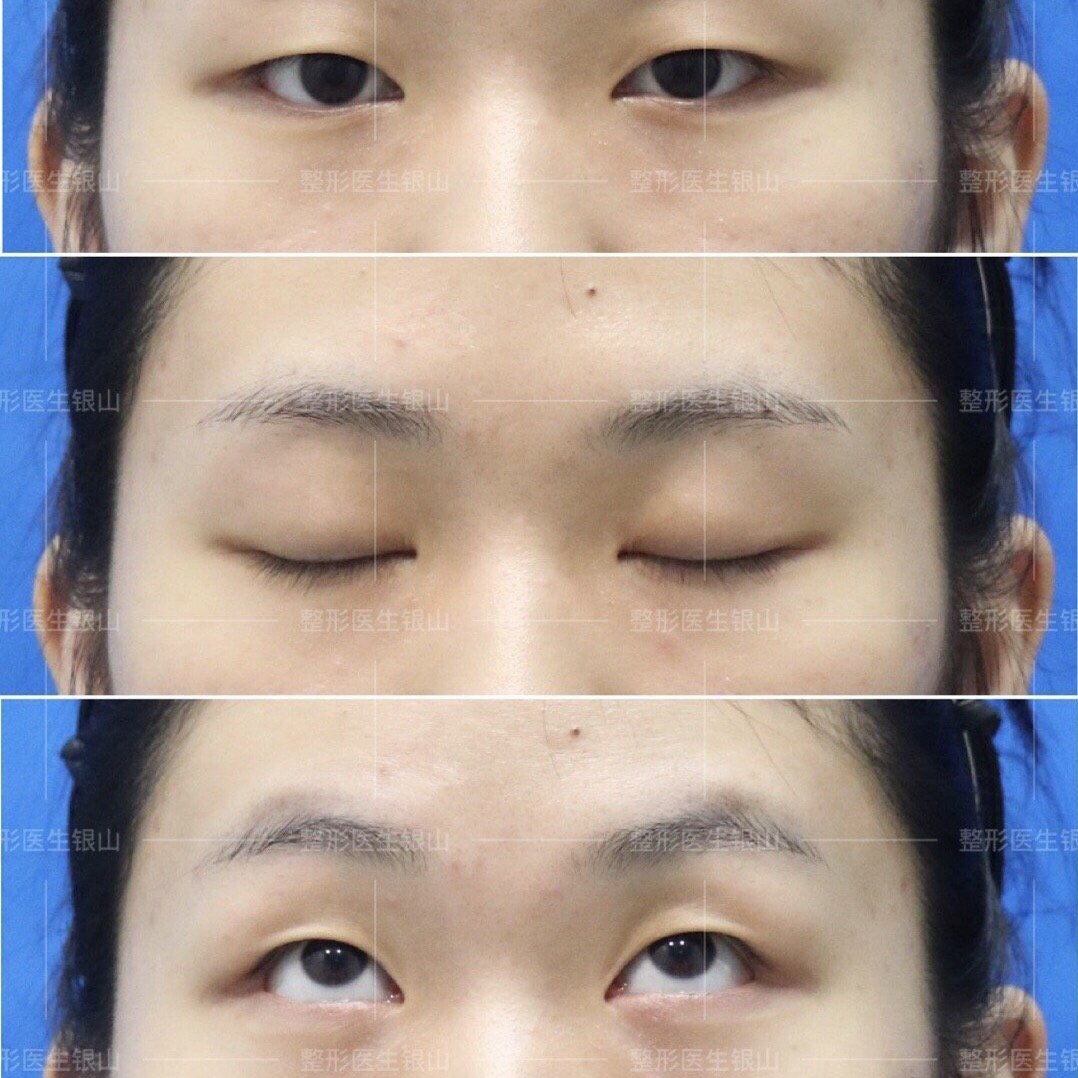 双眼皮重睑切开 上睑提肌(轻度)术后即刻.