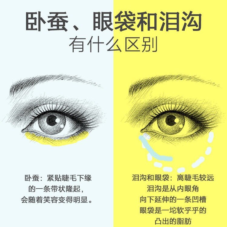 卧蚕填充适合你吗 估计很多人都在网上看过 圈子 新氧美容整形