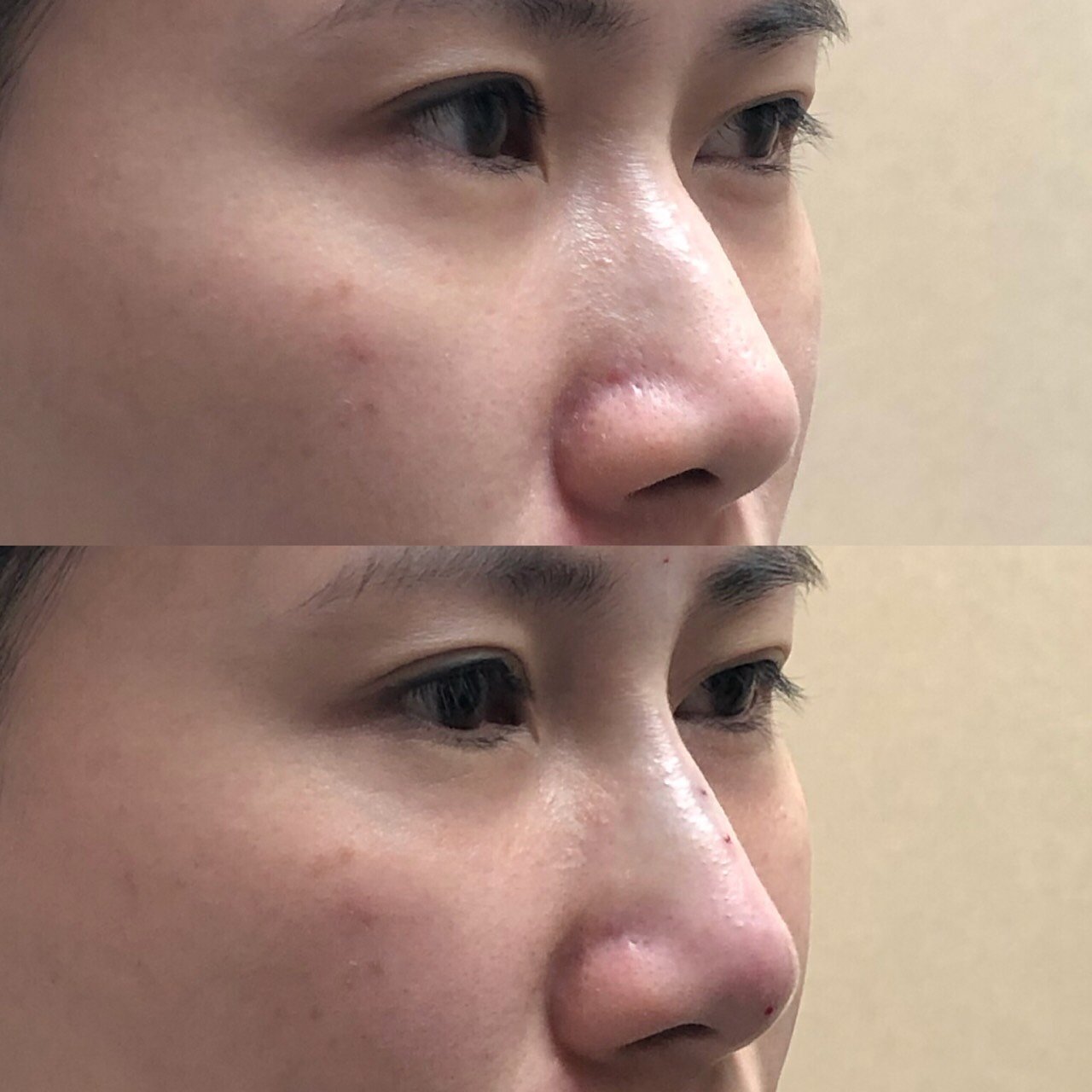 埋线鼻子收窄鼻翼改善鼻节前后对比图