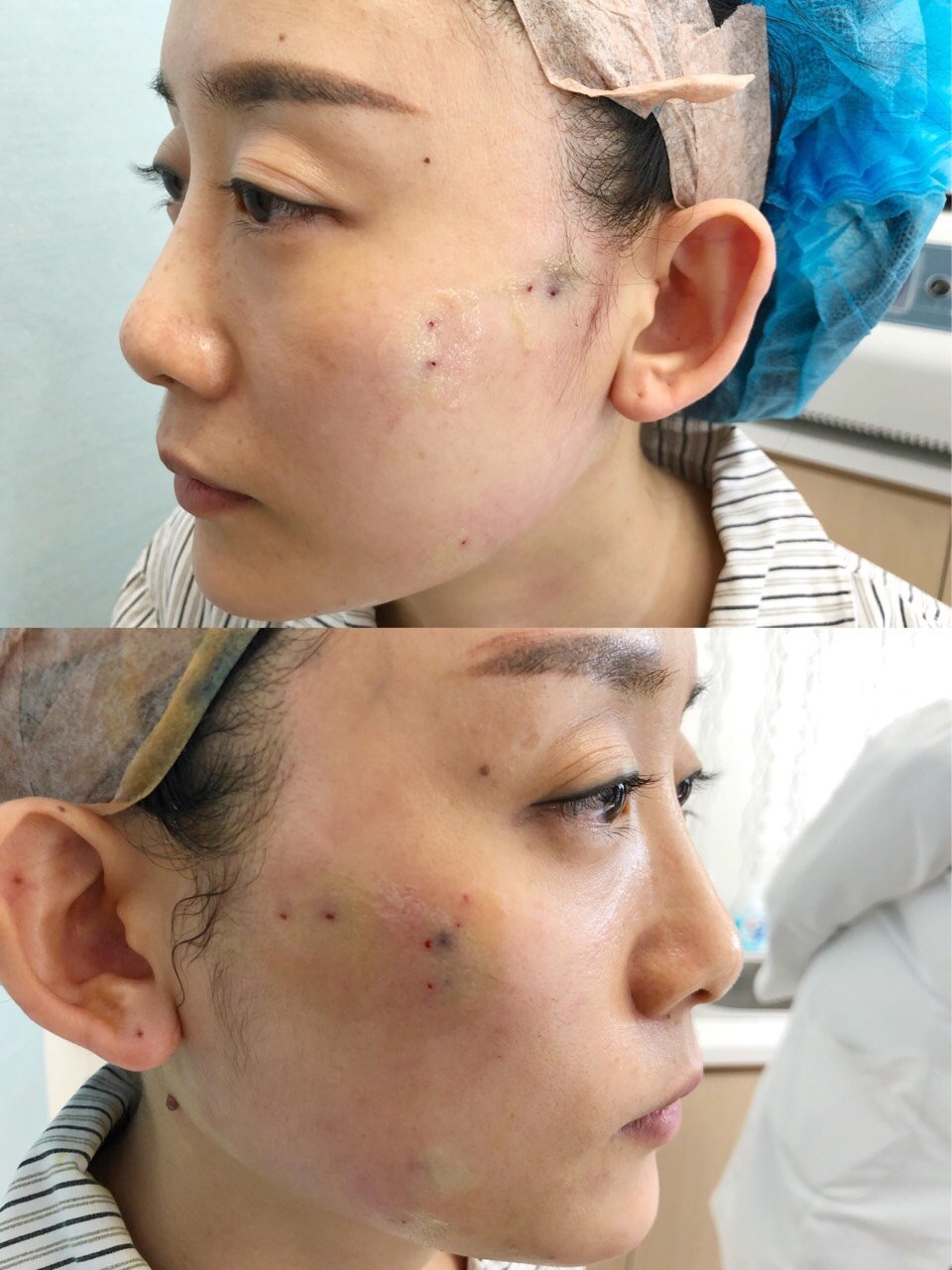 这两月一直没怎么更新笔记,原因正是因为我去做了线雕手术,期间调理