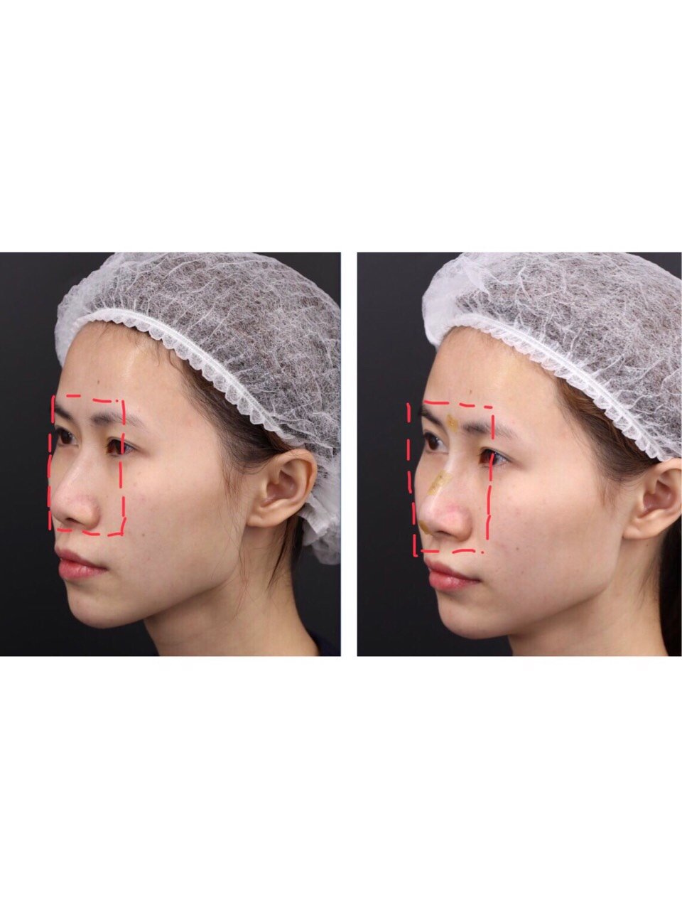 埋线鼻子收窄鼻翼改善鼻节前后对比图