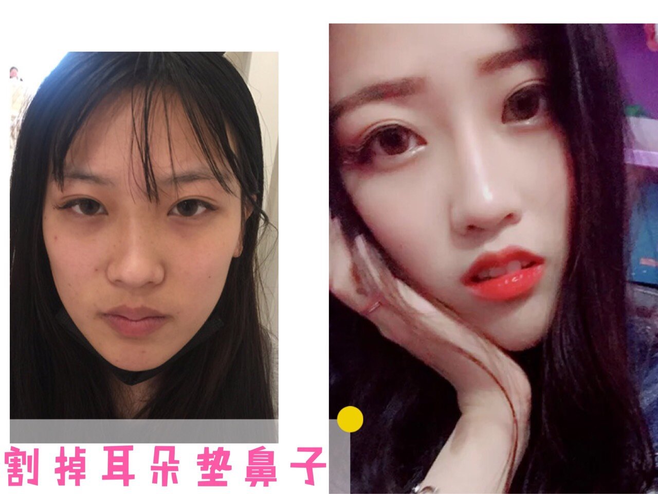 99"耳软骨垫鼻尖"就是取用耳_圈子-新氧美容整形
