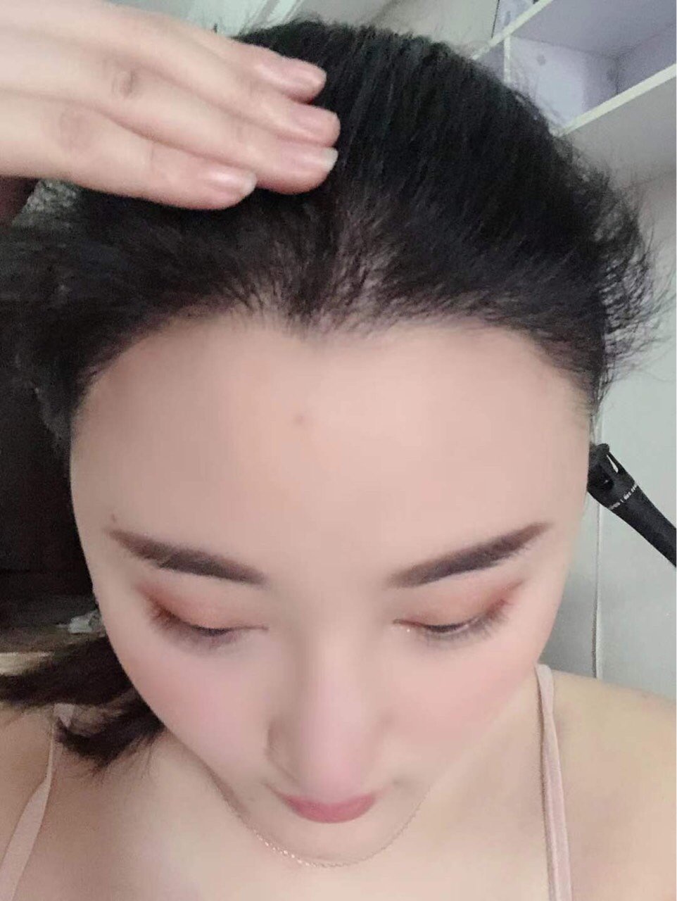 979797现在是科发源术后植发两个月979797种植的发际线