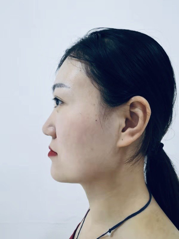 【提升面部立体感,不动骨也可改善脸型】