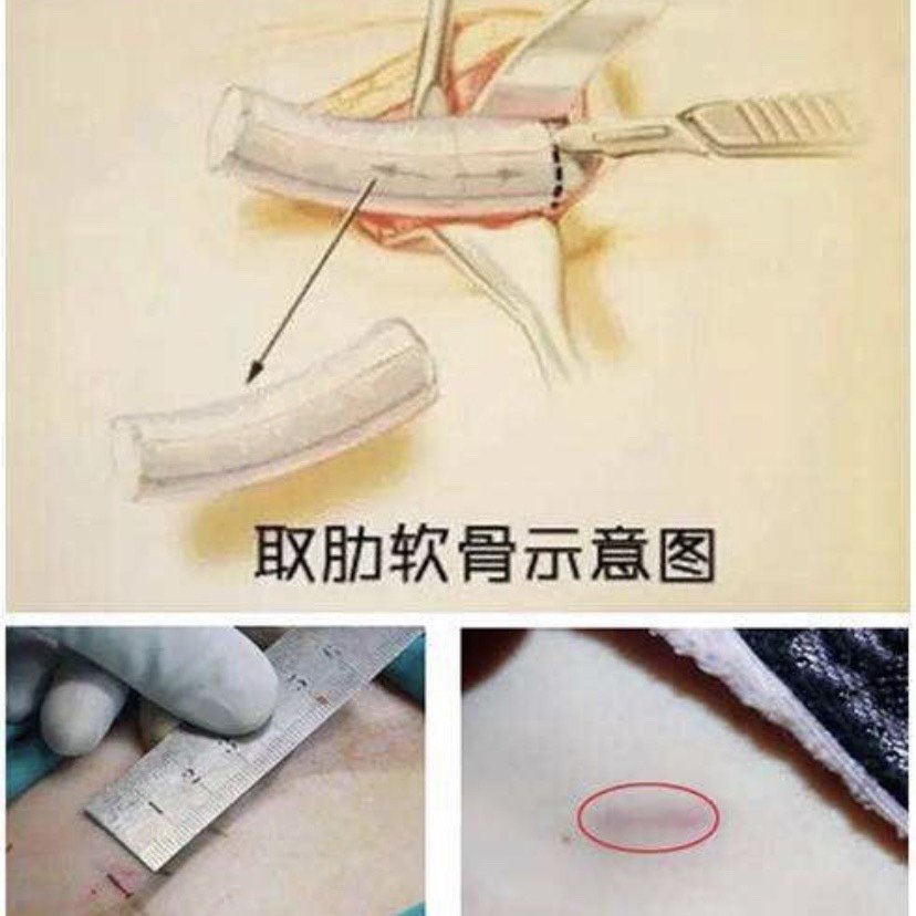 1,取肋软骨的疼痛问题,及切口瘢痕问题
