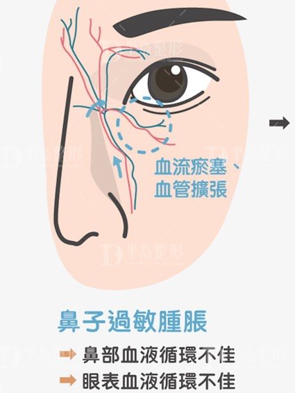 黑眼圈有哪几种类型以及怎么修复呢 新氧美容整形