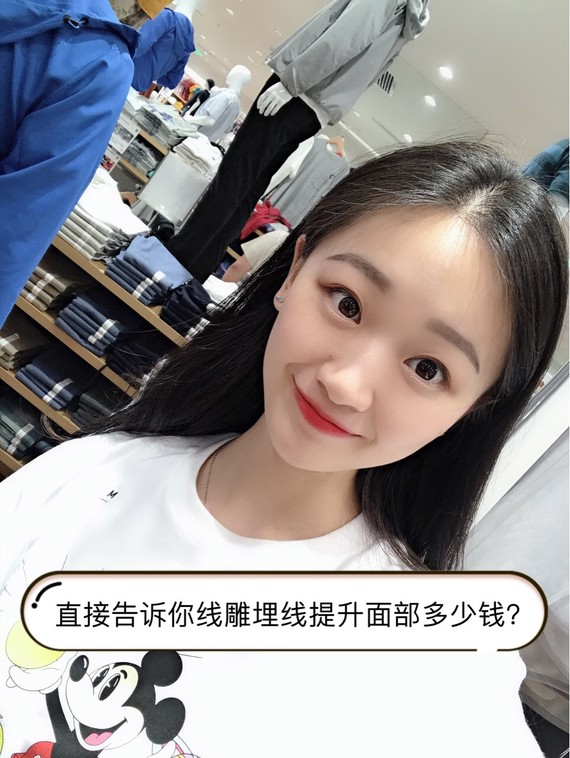 直接告诉你线雕埋线提升面部多少钱面部线雕大