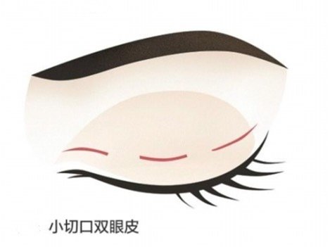 双眼皮手术怎么选?牙签自测法拿走不谢