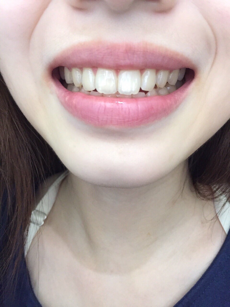 牙齿美白 第一次体验皓齿美白,分享给大家一些心得