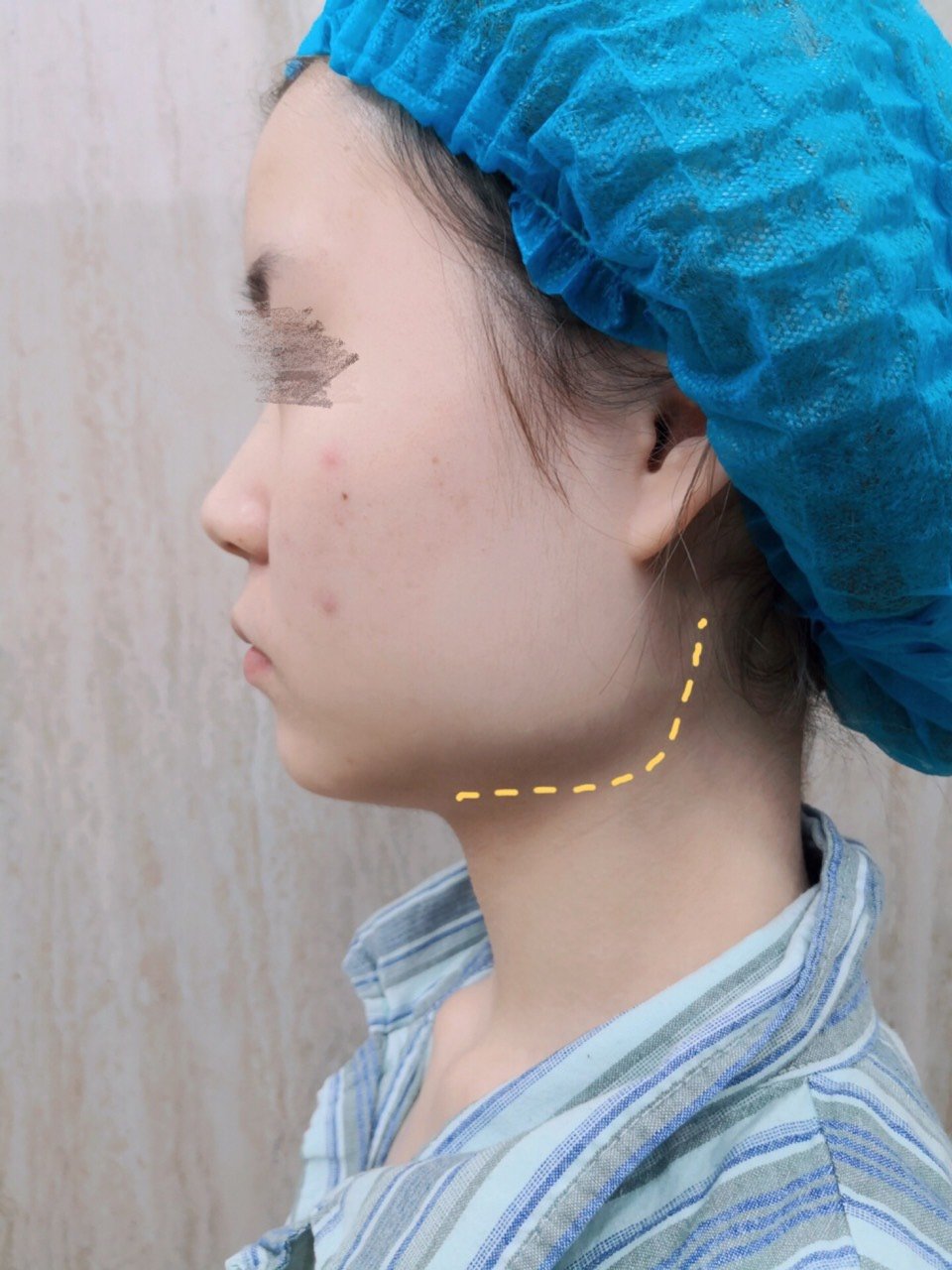 后悔年轻时磨骨,磨骨后脸下垂了后悔了,你知道脸部磨骨后遗症