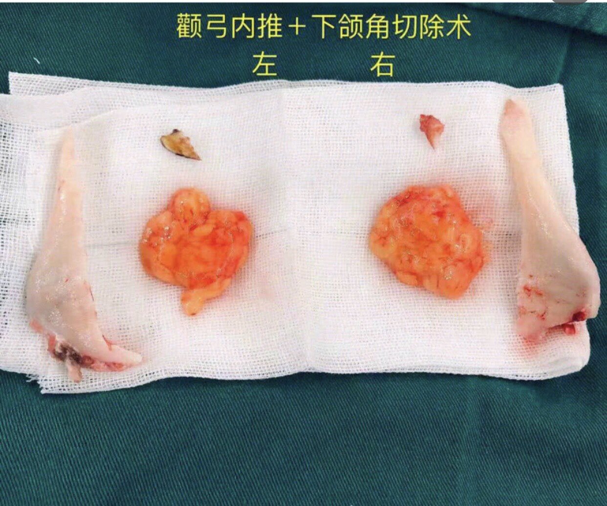 外两层全部切除,再对余下颌骨外板的边缘继续打磨变薄的整形手术