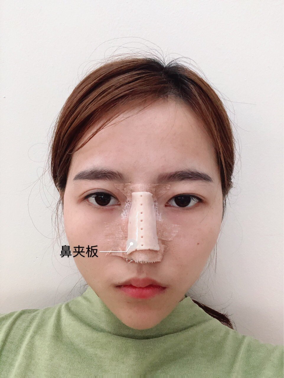 鼻部多项隆鼻后要戴鼻夹板多长时间71