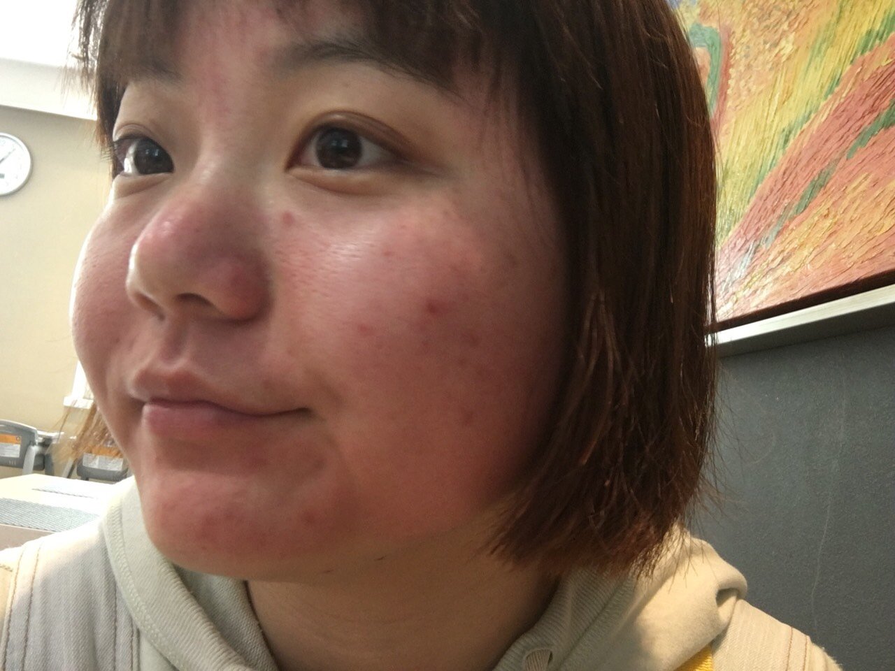 热气腾腾的红肿脸!