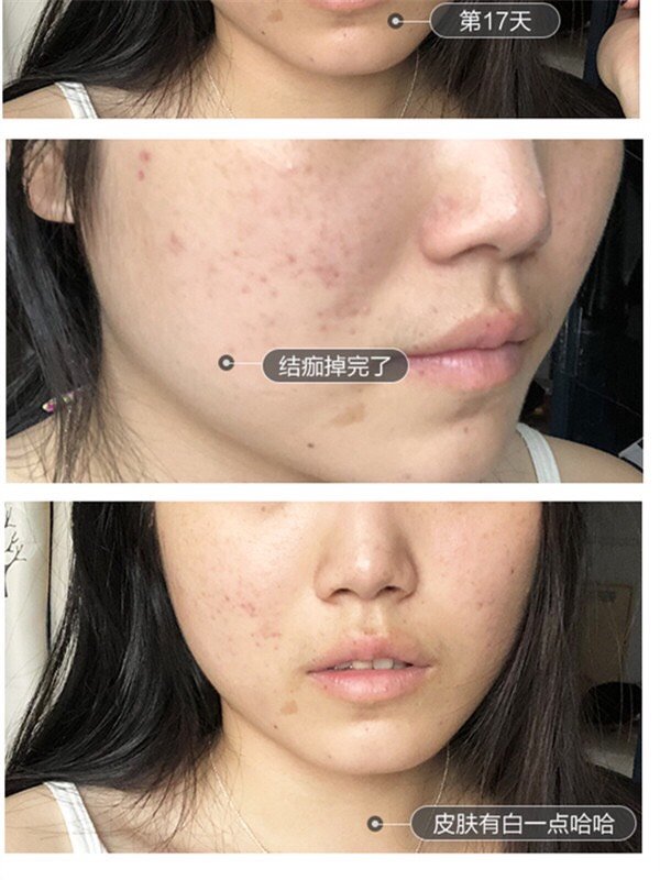 变美经验分享#做完光子嫩肤后反黑正常吗?