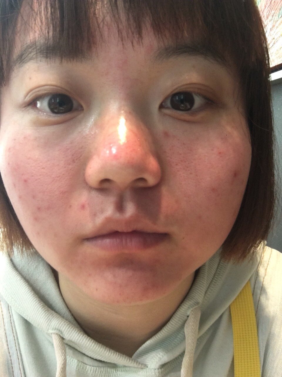 热气腾腾的红肿脸!