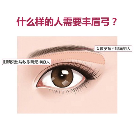 假体丰眉弓会下滑吗