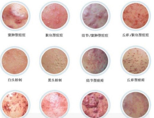 下巴长痘还有红印怎么去掉长沙半岛医学美容医院