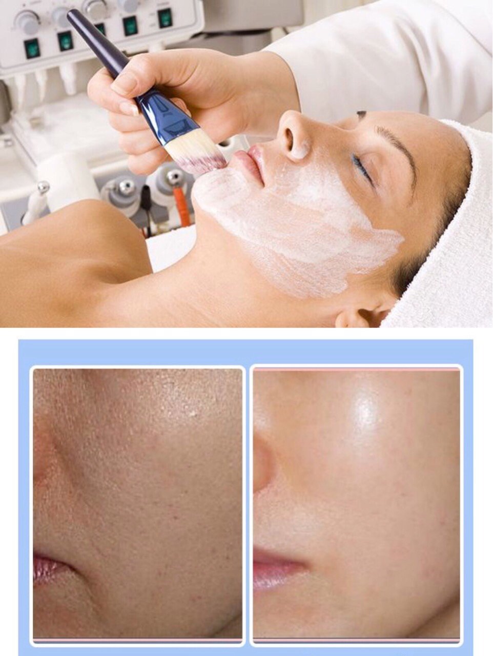 "刷酸"是属于医美范畴的一个项目,它的诞生非常有意_圈子-新氧美容