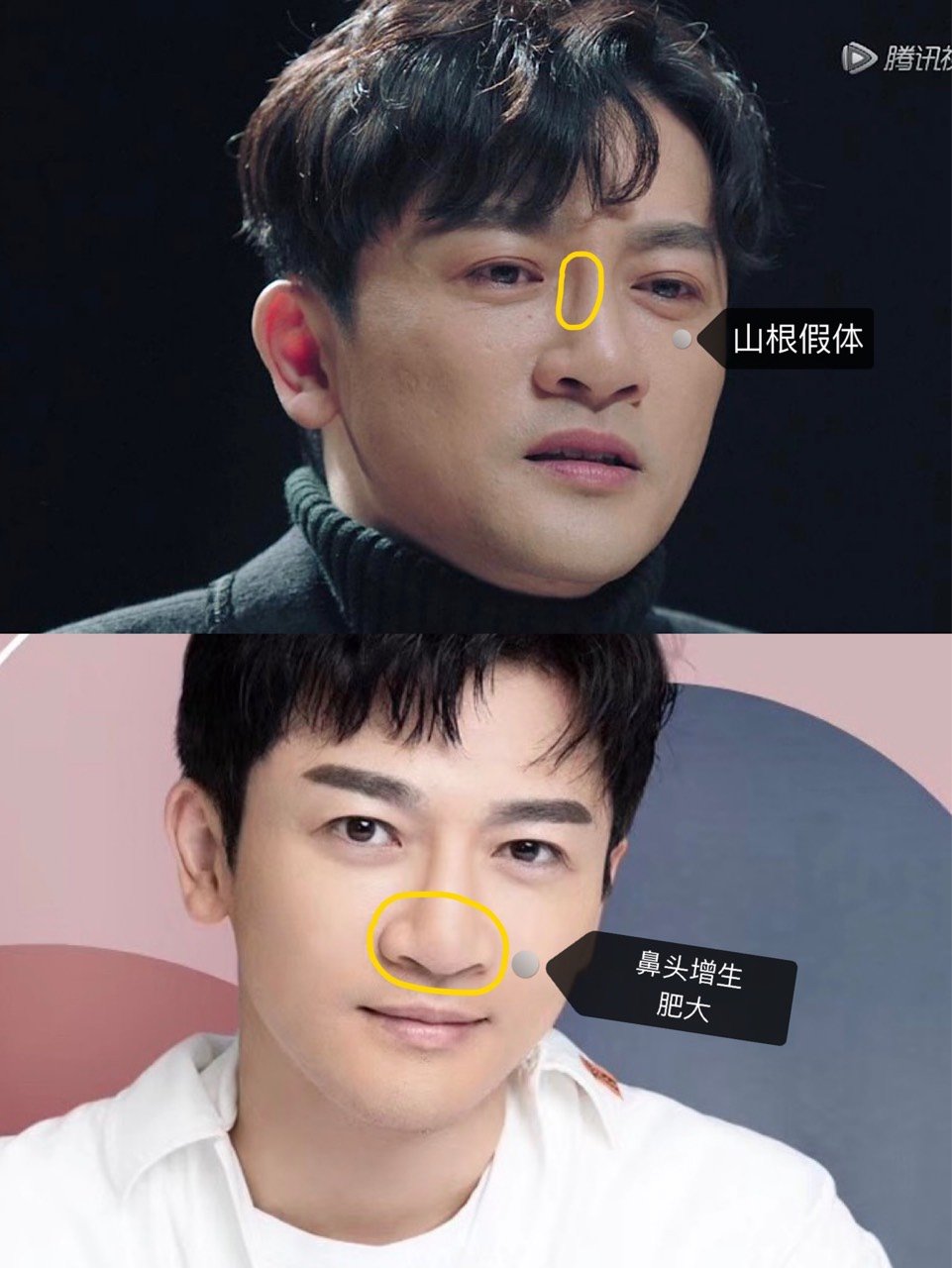 惊!苏有朋的鼻子怎么变成了这样
