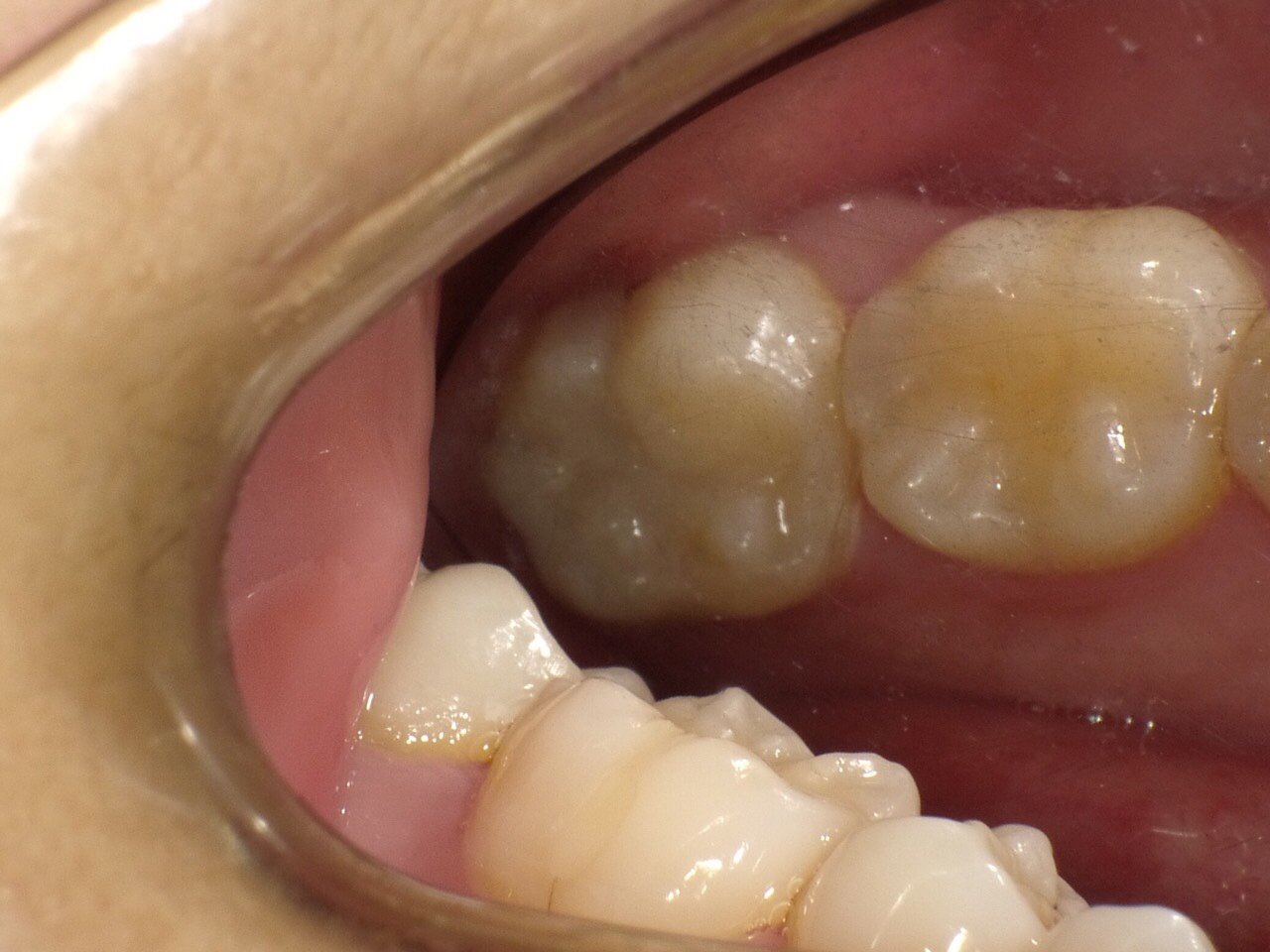 不要犹豫,产品不要蛀牙牙套是什么样子的现龋齿戴牙套得蛀牙龋齿多