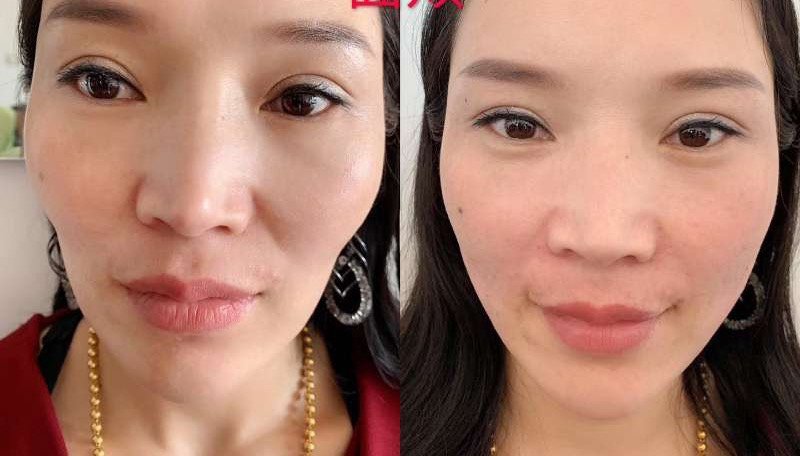 法令纹面颊对比