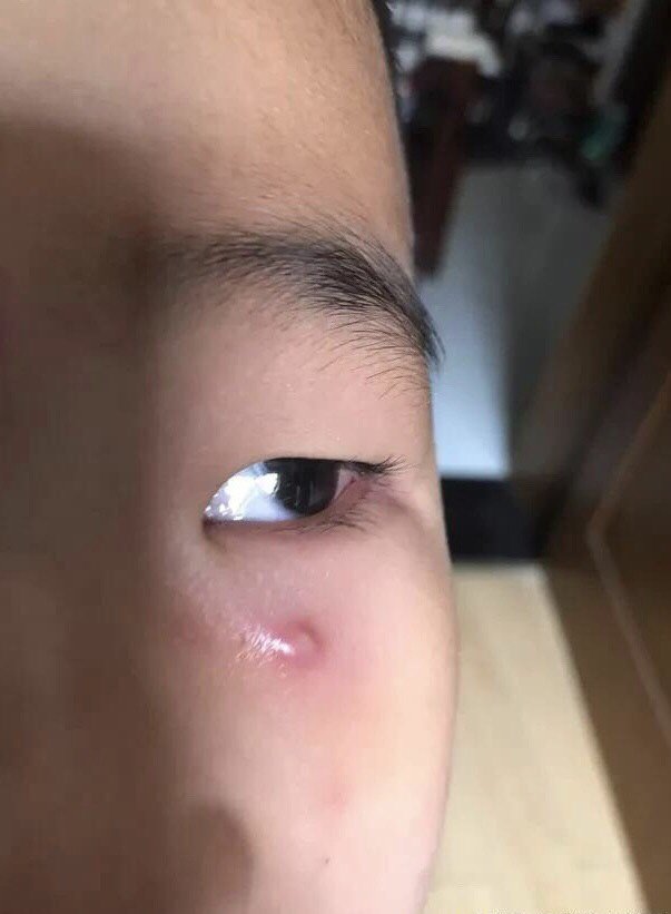 这种包不是痘痘,是毛囊炎这个孩子脸上出现的是一个细_圈子-新氧美容