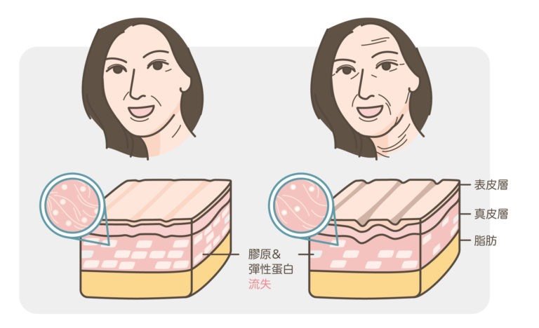 横向颈纹的成因