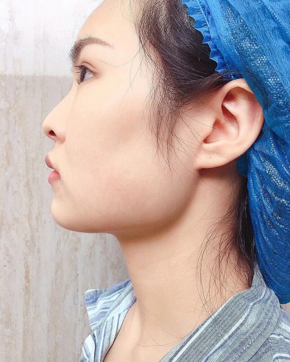 做的项目是下颌角截骨术