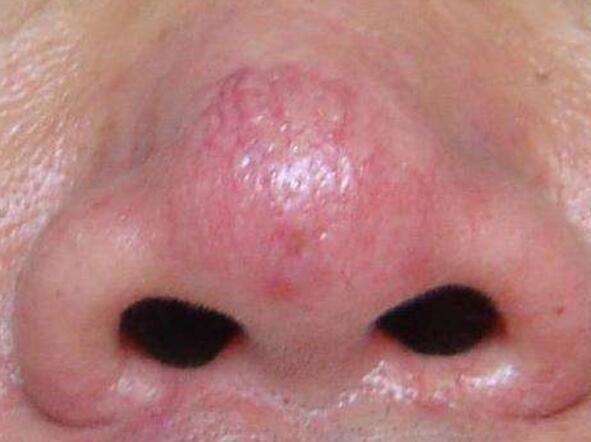 71鼻子上的皮肤很烂真的不能做鼻整形吗?