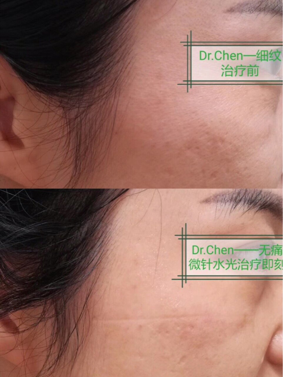 微针水光案例分享