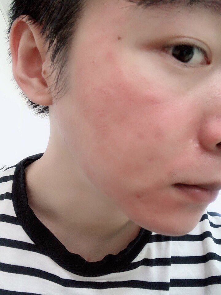 的输送管道【应该就是针孔的意思】,将多种营养成分直接渗入皮肤深层