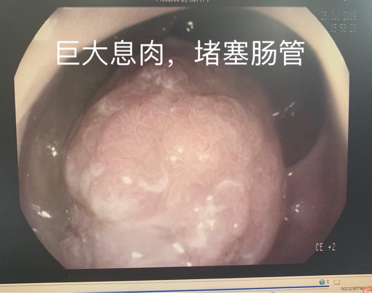 大便变细,排便次数增多,要小心肠癌