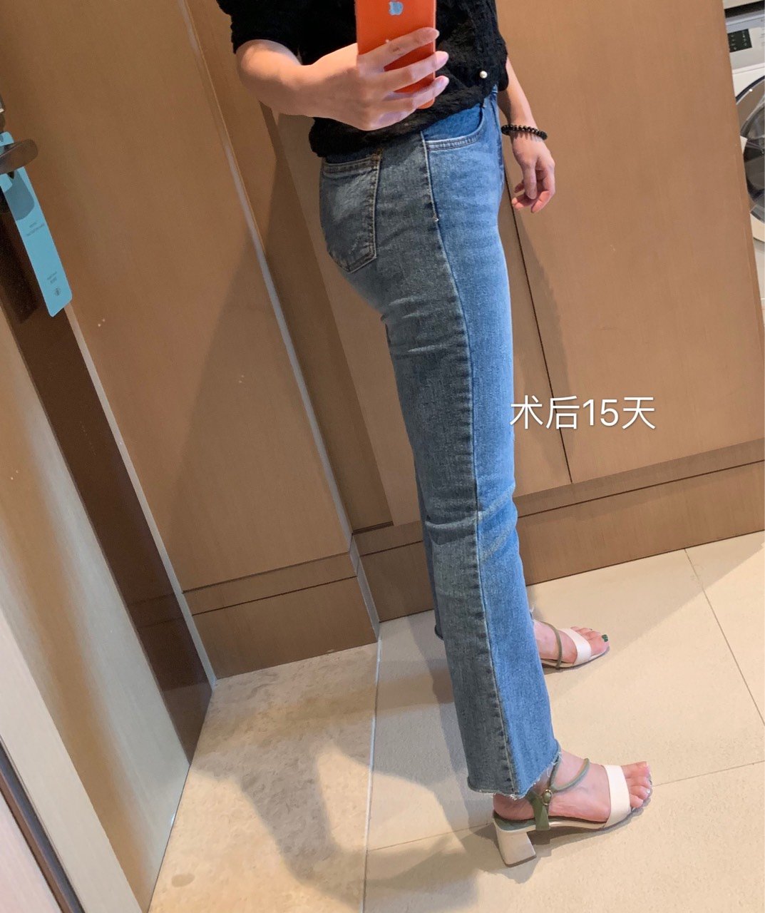 大腿吸脂#媽媽臀吸脂#臀部自體脂肪填充#@盧新蕾_圈子-新氧美容整形