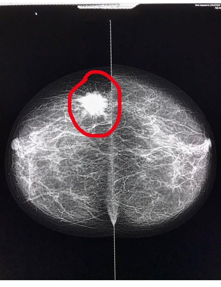 乳腺钼靶检查发现的乳腺癌,就是图片上那个白色的肿块,边界不清楚,有